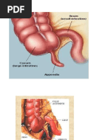 Apendicitis