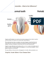 Gingivitis Vs Periodontitis