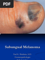 Subungual Melanoma