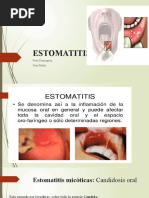 Estomatitis 2