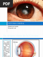 Leucoma Corneal Alejandra Soria