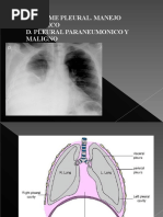 Derrame Pleural MIR