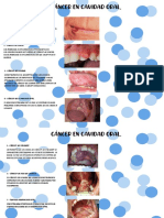 Cancer Cavidad Bucal