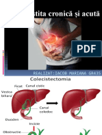 Colicistita Acuta Acalculoasa