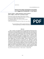 Surgical Treatment of Furcation Involvement Associated With Recurrence of Aggressive Periodontitis - A Case Report-Dikonversi