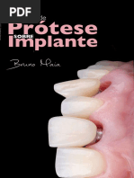 Ebook Protese Sobre Implante Bruno Maia Compressed 1 150