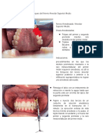 Bloqueo Del Nervio Alveolar Superior Medio