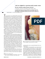 Fiber Reinforced Post and Core