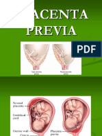 Placenta Previa