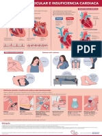 Infografa Insuficiencia Cardiaca - Fibrilacin Auricular