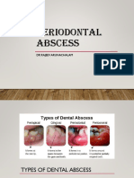 Periodontal Abscess: DR - Rajeev Arunachalam