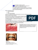 Fibroma Osificante Periférico. Se Trata de Un Nódulo Gingival, Ocasionado Por La