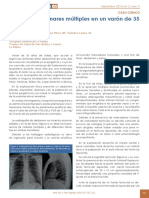 Nódulos Pulmonares Múltiples en Un Varón de 35 Años