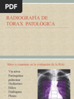 Radiografía de Tórax Patológica