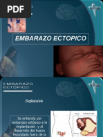 Embarazo Ectopico