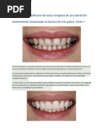 Full-Mouth Adhesive Rehabilitation Part. 1.en - Es