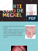 Diverticulo de Meckel