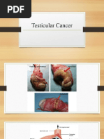 Testicular Cancer