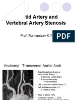 Carotid Artery Disease