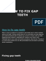 How To Fix Gap Teeth