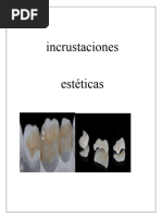 Incrustaciones ESTETICAS