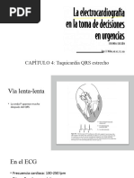 ECG Wellens - Taquicardia QRS Estrecho PARTE II