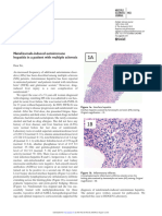 Martínez-Lapiscina Et Al Natalizumab-Induced Autoimmune Hepatitis in A Patient With Multiple Sclerosis