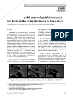 Neumatizacion Del Seno Esfenoidal Evaluada Con Tom