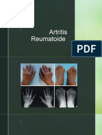 Artritis Reumatoide