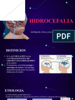 HIDROCEFALIA 