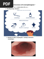 Carcinoma of Oesophagus