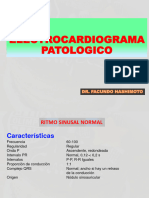 Electrocardiograma Patologico