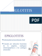 Epiglotitis