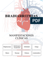 Bradiarritmias