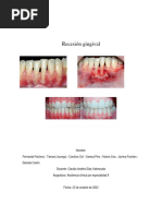 Recesión Gingival