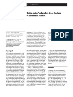 Treatment of Distal Calvicula Fracture