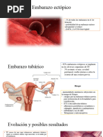 Embarazo Ectópico