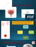 Tumores Vesicales
