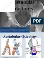 Fractures of Acetabulum