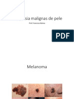 Neoplasias Malignas Da Pele