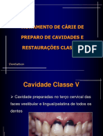 Tratamento de Cárie de Preparo de Cavidades E Restaurações Classe V