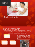 Endometriosis Final