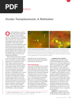 Ocular Toxoplasmosis