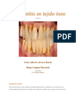 Periodontitis en Tejido Oseo