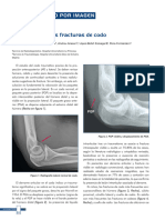 Semiología de Las Fracturas de Codo: Iagnóstico Por Imagen