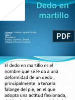 Dedo en Martillo