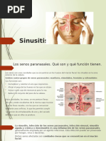 Sinusitis Aguda y Cronica