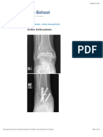 Ankle Arthrodesis - The Bone School