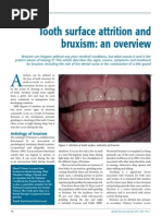 A-Attrition and Bruxism