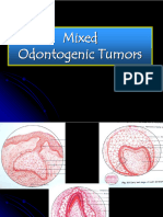 Mixed Odontogenic Tumours